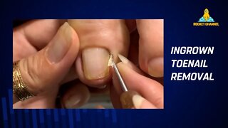 INGROWN TOENAIL REMOVAL AND CLEANING - PODOLOGY