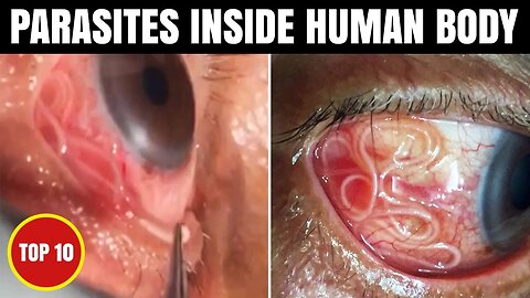 10 Parasites That Can Be Found Inside The Body