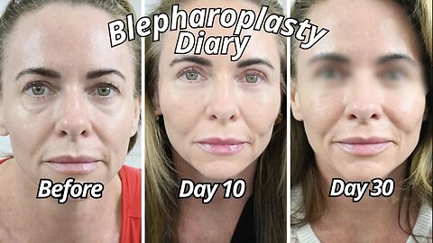 Day 30 Transformation After Eyelid Lift Surgery