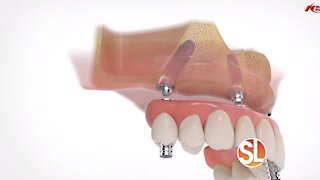 Gasser Dental Implants: "Changing Lives One Smile At a Time"