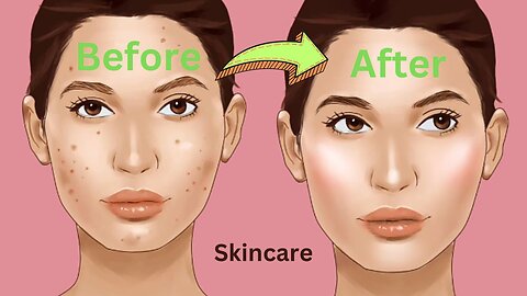 Skincare routine for acne-prone skin ANIMATED