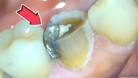 Dental Crown Procedure { Zirconia Crown Preparation w/ Microscope }