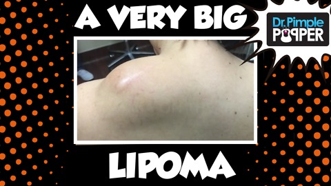 Excision of a Large Lipoma on the Shoulder using Tumescent Technique