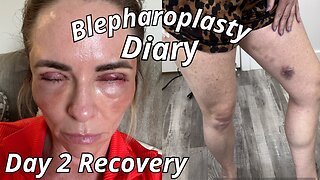 Navigating the Aftermath of My Blepharoplasty Recovery | Day 2