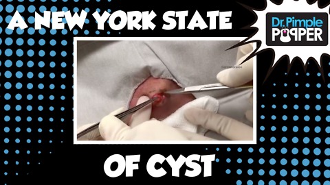 A New York State of Cyst
