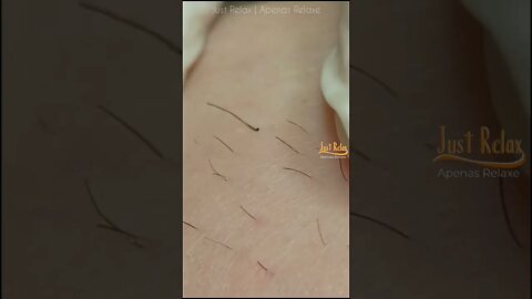 Vídeo Satisfatório Eletrólise Depilação Elétrica Definitiva 2 - Relaxing and Satisfying Electrolysis