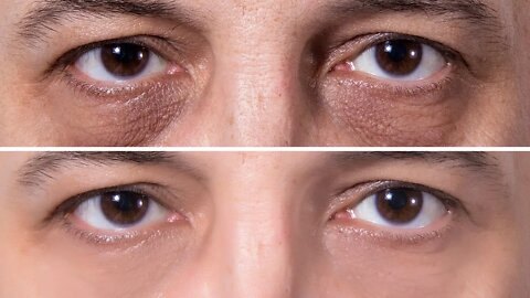 How To Get Rid of Dark Circles Permanently