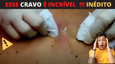 ESPREMENDO CRAVOS Removendo Cravos Gigantes Espremendo Cravos e Espinhas Removendo Acne ACNE