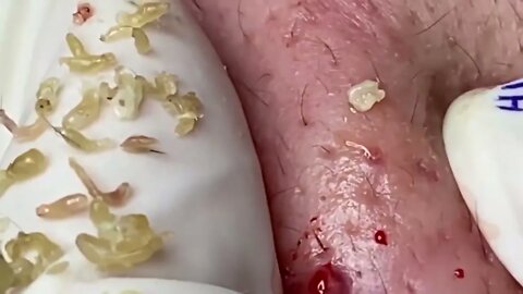 blackhead extraction/removal to relax that day!