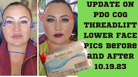 UPDATES PDO COGS THREADLIFT LOWER FACE BEFORE AND AFTER 10.19.23 #pdothreads #threadlift