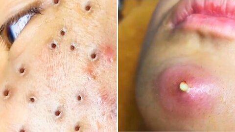 Popping Giant Pimple & Popping Huge Blackheads Best Pimple Popping Video