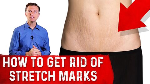 How To Get Rid of Stretch Marks After Pregnancy? – Dr. Berg