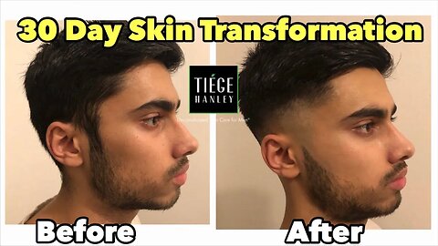 30 DAY HONEST SKIN TRANSFORMATION REVIEW WITH TIEGE HANLEY (For Men)