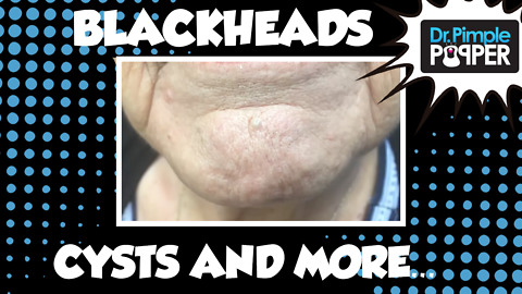 Blackheads, Milia, Inflamed Cyst & MORE!