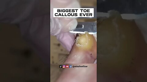 SHAVING OF REAL BIG TOE CALLUS 🦶 BIGGEST TOE CALLOUS EVER FULL TREATMENT BY MISS FOOT FIXER