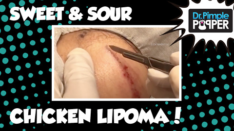 Sweet and Sour Chicken Lipoma