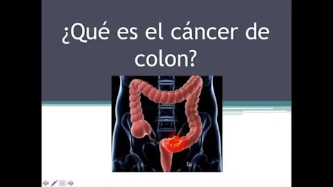 ¿Qué es el cáncer de colon?