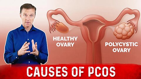 3 Causes of Polycystic Ovarian Syndrome (PCOS) & High Androgens – Dr. Berg