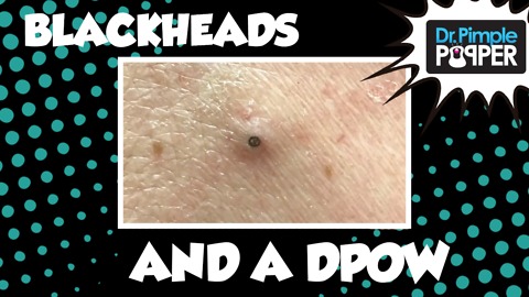 Dr Pimple Popper: Blackheads and a Flippy Dilated Pore of Winer