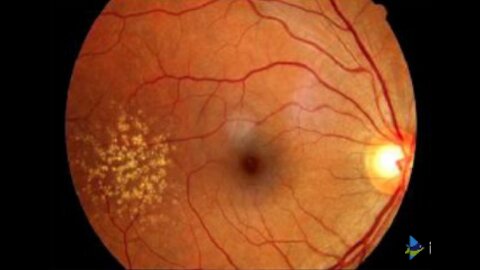 Best and Worst Foods for Macular (Retina) Degeneration
