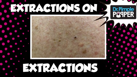Extractions on Extractions!