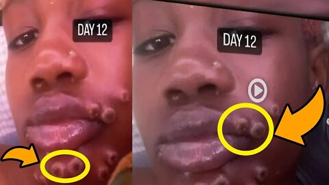 monkey pox infection 😱 woman tells story Camille Seaton