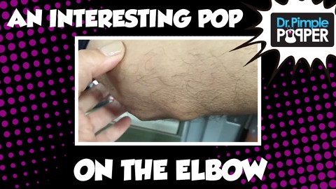 An interesting POP on the elbow