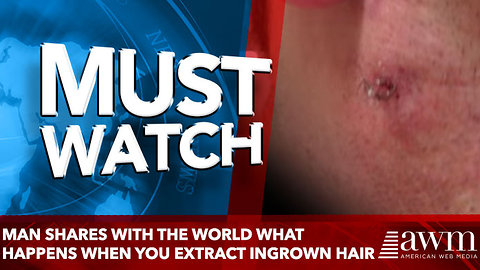 Man Shares With The World What Happens When You Extract A Massive Ingrown Hair