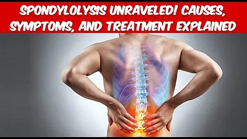 Cracking the Code: Spondylolysis Unraveled! Causes, Symptoms, and Treatment Explained