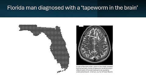 Florida man diagnosed with a 'tapeworm in the brain'