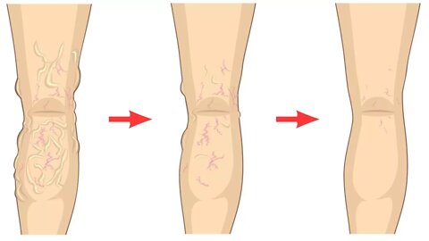 How to Get Rid of Varicose Veins Naturally