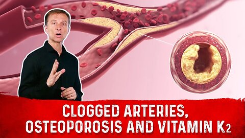 Clogged Arteries, Osteoporosis and Vitamin K2 – Dr. Berg