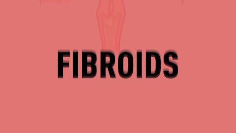 Everything Black Women Need To Know About Fibroids From A Black Doctor | Healthy Her