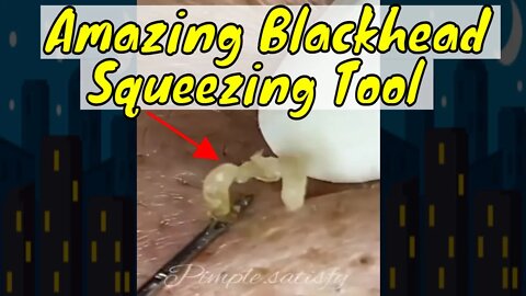 Amazing blackhead squeezing tool 🪱 #blackheadremoval #blackhead #blackheads #blackheadremoval #fyp