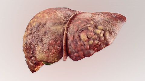 A Man Drank 3 Liters Rum Everyday Since Age 13. This is What Happened To His Liver.
