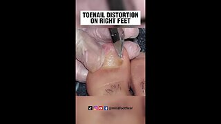 TOENAIL DISTORTION ON RIGHT FEET FULL TREATMENT BY FAMOUS PODIATRIST MISS FOOT FIXER