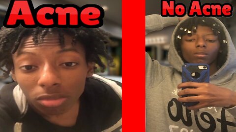 Pheanx Shows You How To Get Rid Of Acne (Acne Tutorial Ep.5)