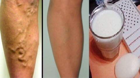 Home Remedy To Remove Varicose Veins and Thrombosis with Only 2 Simple Ingredients