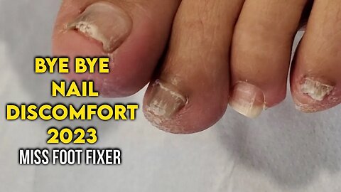 BYE BYE NAIL DISCOMFORT [ SATISFYING NAILS CLEANING ] 2023 BY FAMOUS PODIATRIST MISS FOOT FIXER