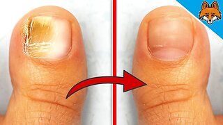 Remove Nail Fungus with THIS Home Remedy 💥 (It couldn't be easier) 🤯