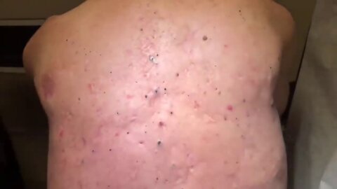 Big Cystic Acne Blackheads Extraction Whiteheads Removal Pimple Popping