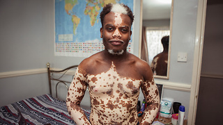 His Vitiligo Is Disappearing, But He Doesn't Want It To