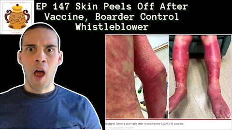 EP 147 Skin Peels Off After Vaccine, Boarder Control Whistleblower