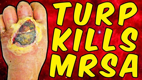 Turpentine Kills MRSA (Scientifically Proven)