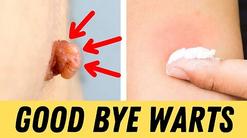 Warts? Say Goodbye with This Simple Home Remedy