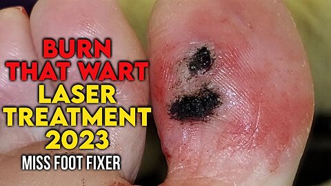 " BURN THAT WART " LASER TREATMENT FOR FOOT WART [2023] BY FOOT SPECIALIST MISS FOOT FIXER