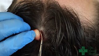 Removal on an Intact Pilar Cyst