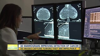 3D Mammograms Improving Detection Of Cancer