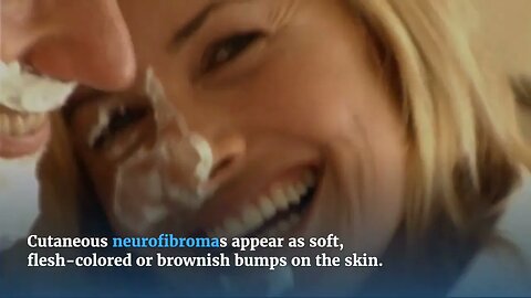 What is the most common tumor in neurofibromatosis | neurofibromatosis #nofearwithneurofibromatosis