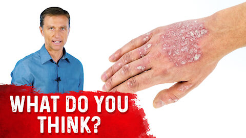 Is Psoriasis Contagious?